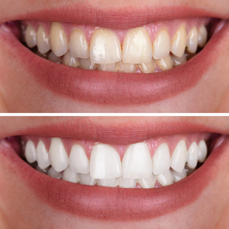 Blanqueamiento profesional: sin necesidad de ir al dentista.