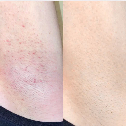 Heals Your Skin While Weakening Hair (No More Bumps, Burns, or Dark Spots)