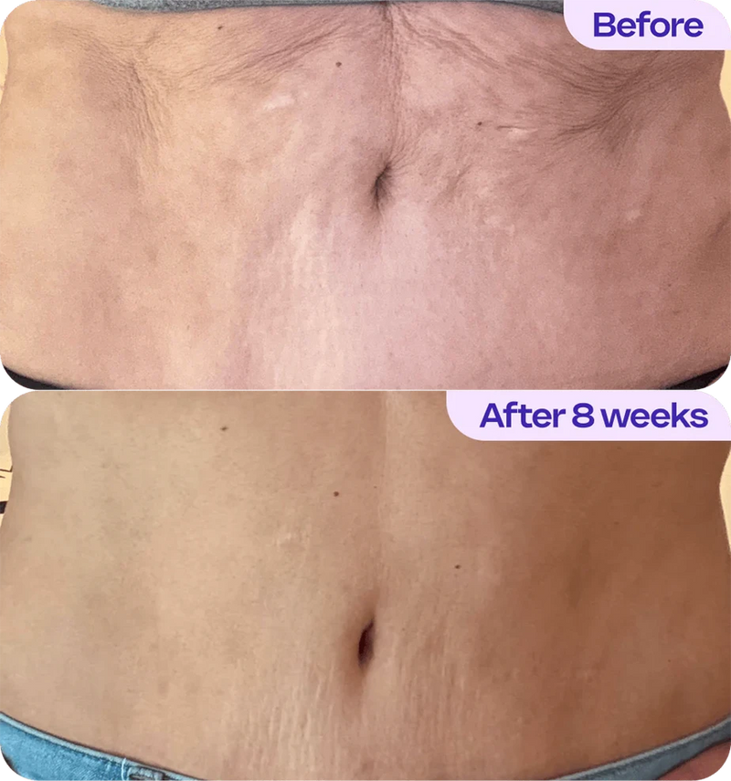 1. Helps Your Belly Skin Look Tighter, Smoother, and More Toned