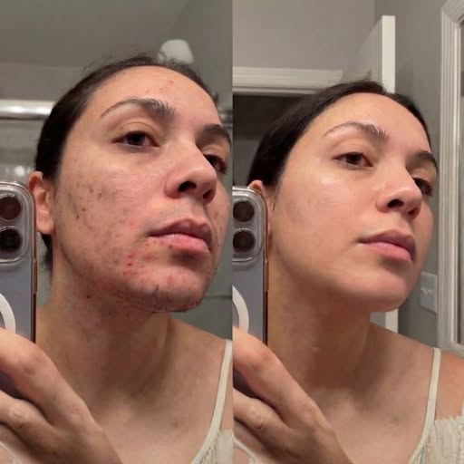 It Breaks the Exhausting Daily Hair Removal Cycle (Finally, Freedom Without Pain)