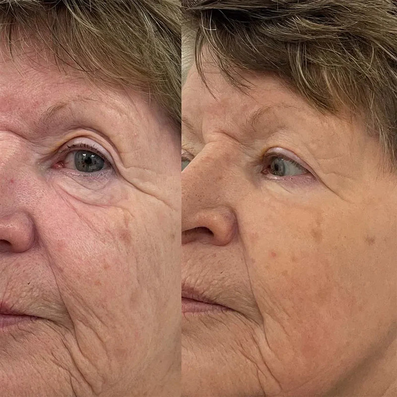 Filler Effect, Zero Needles
