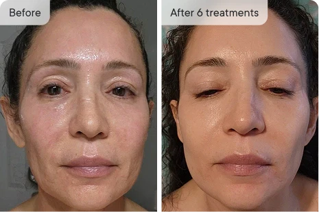 Professional Microneedling at Home — Without the $300 Price Tag or Appointment Wait