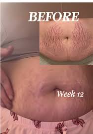 NovaGlow's Belly Serum