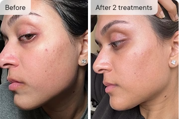 Pain-Free With Zero Downtime — Use It Before Work, Before a Date, Anytime