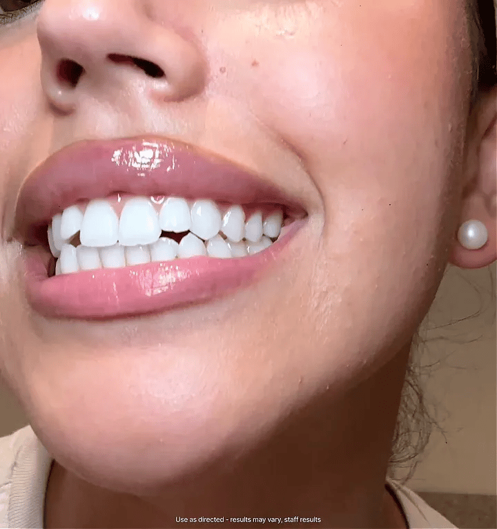 It Whitens Your Teeth Without the Pain, the Trays, or the Dentist Bill