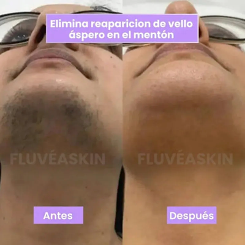 Cyperus Rotundus Hair Growth Reduction Serum  Best Seller