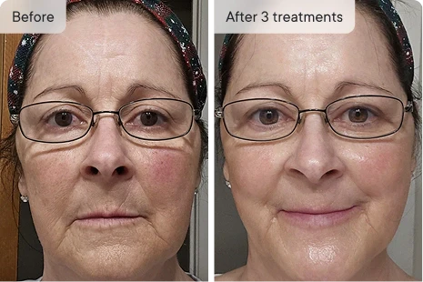 Boosts Absorption 20x — So Fine Lines, Dark Spots & Dullness Finally Fade